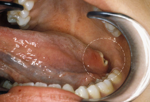 Base Of Tongue Cancer Symptoms