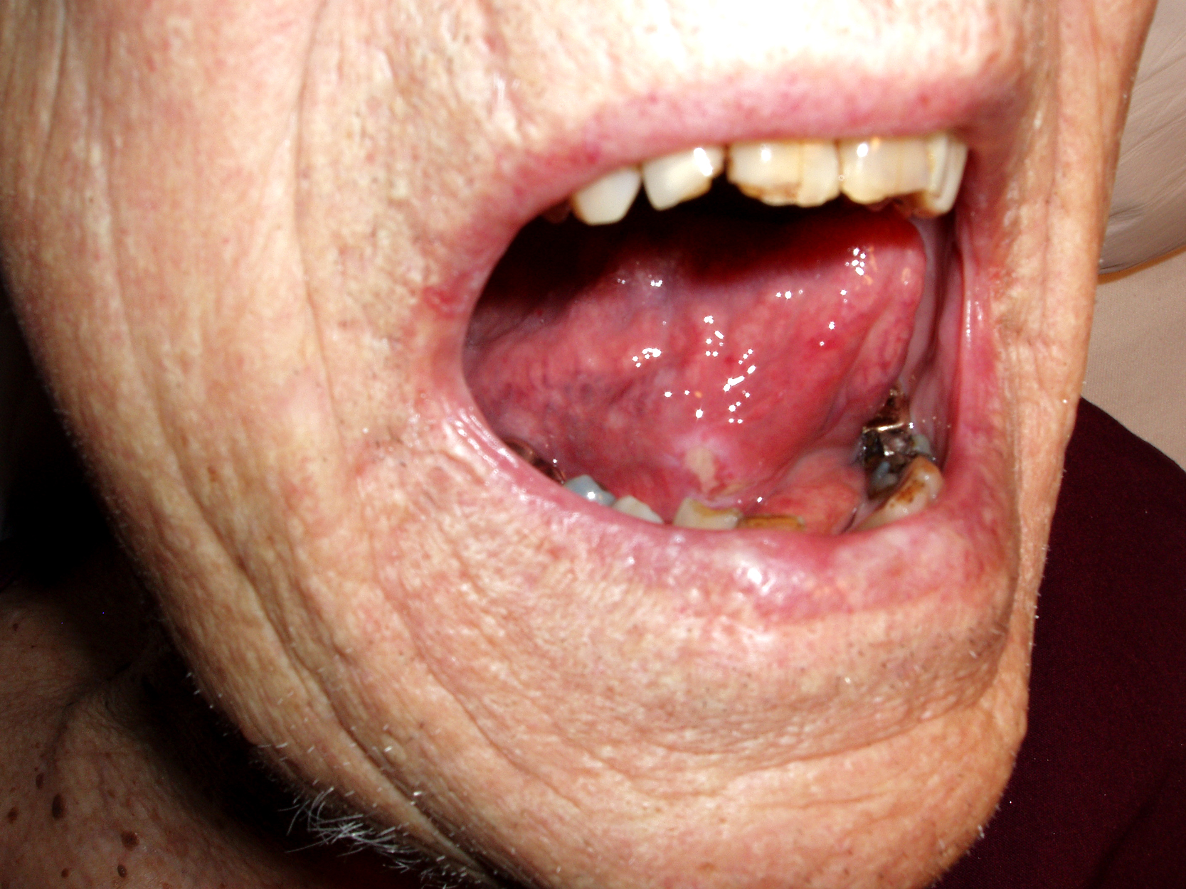 Base Of Tongue Cancer Symptoms