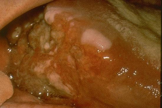 Base Of Tongue Cancer Symptoms