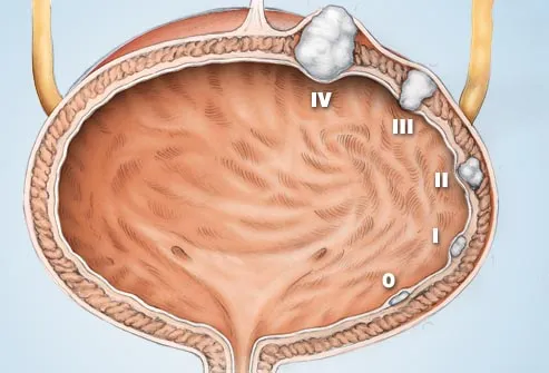 Bladder Cancer Symptoms