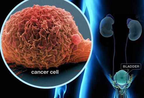 Bladder Cancer Treatment