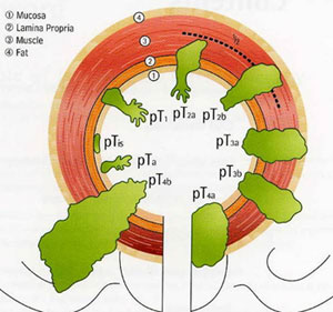 Bladder Cancer Treatment