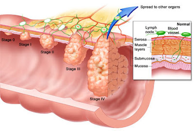 Bowel Cancer Symptoms In Women Pics