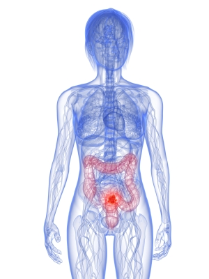 Bowel Cancer Symptoms In Women Pics