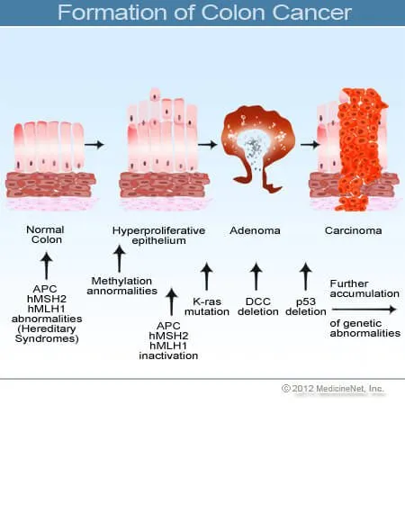 Bowel Cancer Symptoms Mayo Clinic