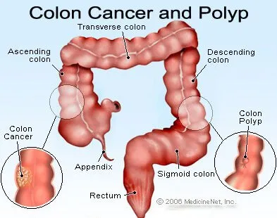 Bowel Cancer Symptoms Mayo Clinic