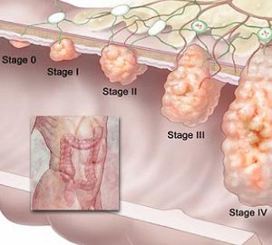 Breast Cancer Symptoms And Signs