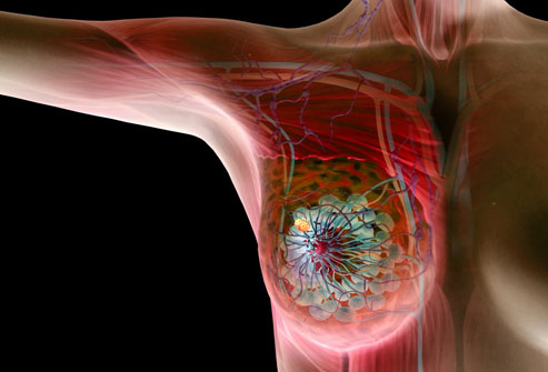 Breast Cancer Symptoms And Signs