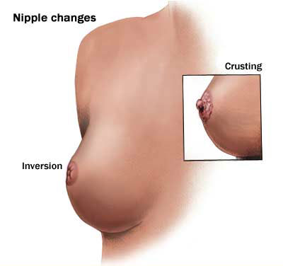 Breast Cancer Symptoms And Signs For Women