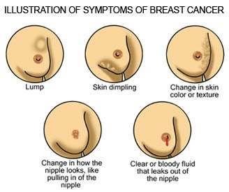 Breast Cancer Symptoms And Signs Pictures