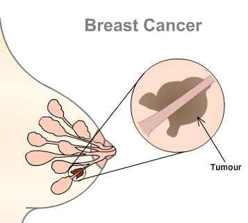 Breast Cancer Symptoms Images