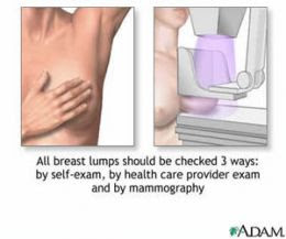 Breast Cancer Symptoms Images