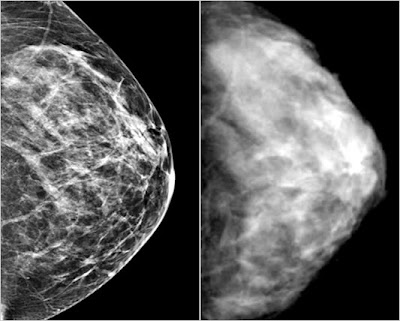 Breast Cancer Symptoms In Women Over 50