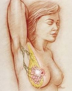 Breast Cancer Symptoms Photos