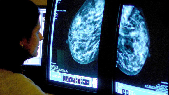 Breast Cancer Treatment Costs Uk