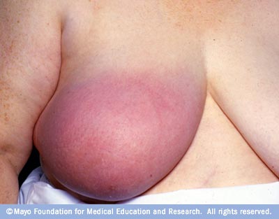 Can Inflammatory Breast Cancer Symptoms Come And Go