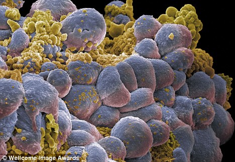 Cancer Cells In Human Body