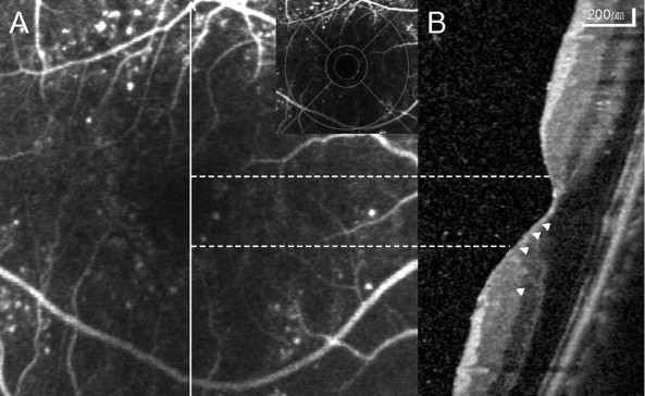 Cellophane Maculopathy Definition