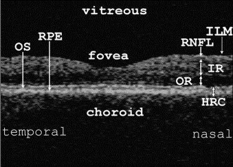 Cellophane Maculopathy Definition