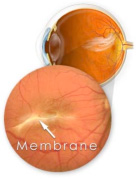 Cellophane Maculopathy Symptoms