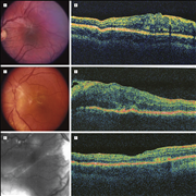 Cellophane Maculopathy Symptoms