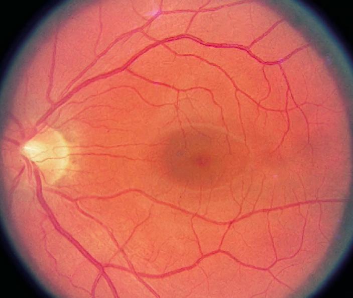 Cellophane Maculopathy Symptoms