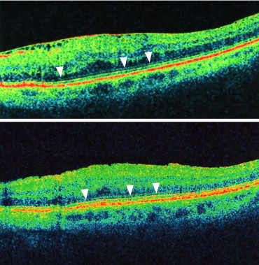 Cellophane Maculopathy Symptoms