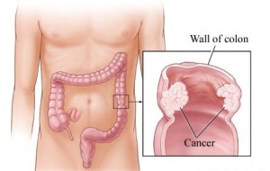 Colon Cancer Symptoms In Men Signs