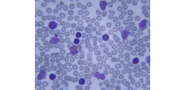 Immature White Blood Cells Images