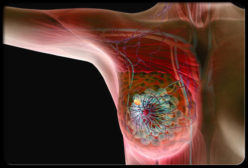 Inflammatory Breast Cancer Symptoms