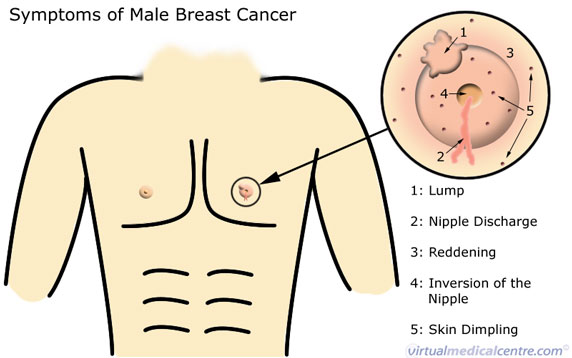 Inflammatory Breast Cancer Symptoms Pictures