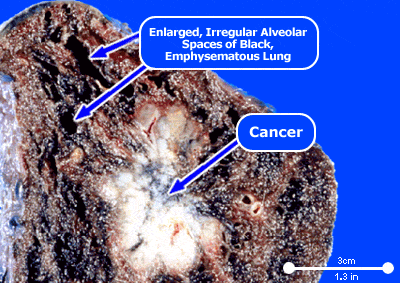Lung Cancer Signs And Symptoms In Men