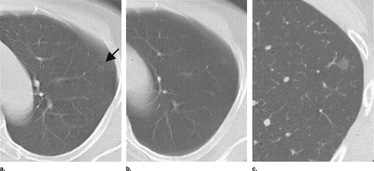 Lung Cancer Symptoms In Women Non Smokers