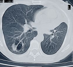 Lung Cancer Treatment Options By Stage