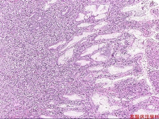 Lymphoma Cells Images