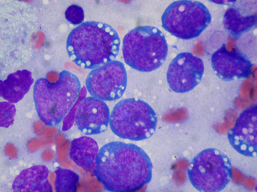 Lymphoma Cells Images
