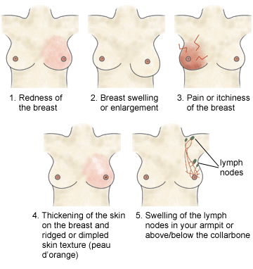 Male Breast Cancer Symptoms And Signs