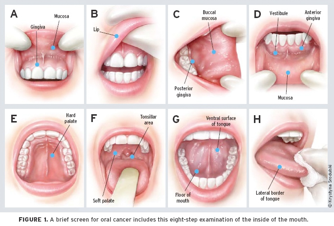 Mouth Cancer Symptoms And Signs Pictures