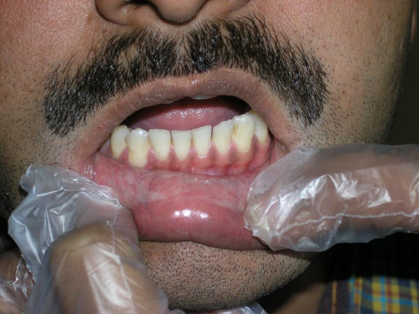 Mouth Cancer Symptoms From Chewing Tobacco