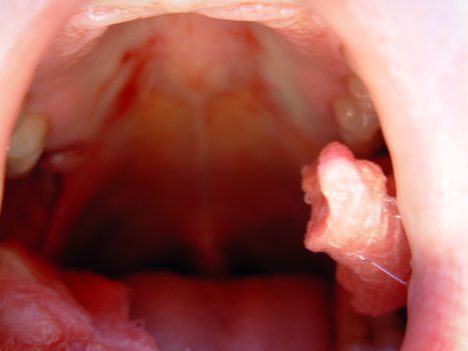 Mouth Cancer Symptoms From Chewing Tobacco