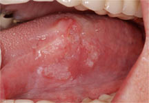 Mouth Cancer Symptoms In Men