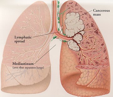 Non Small Cell Lung Cancer Signs And Symptoms