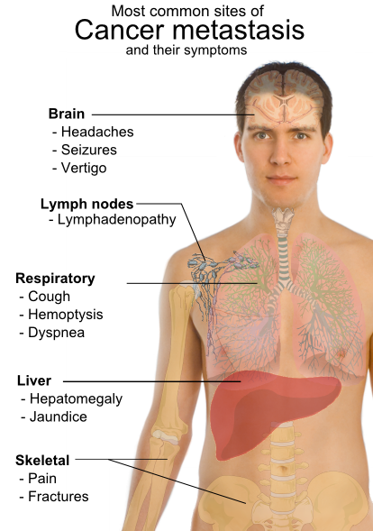 Pancreatic Cancer Symptoms