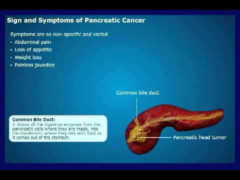 Pancreatic Cancer Symptoms In Young Women