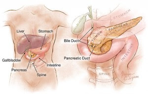 Pancreatic Cancer Symptoms In Young Women