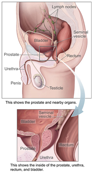 Prostate Cancer Symptoms