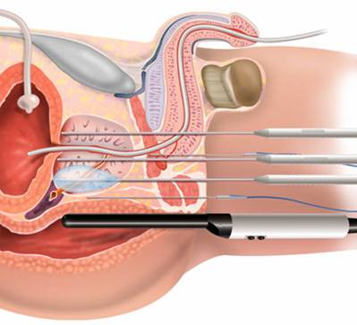 Prostate Cancer Symptoms