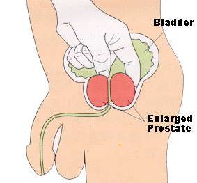 Prostate Cancer Symptoms