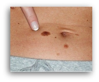 Skin Cancer Symptoms Images