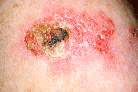 Skin Cancer Symptoms Itching